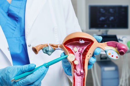 Natural Herbal Remedies for Fibroids and Cysts