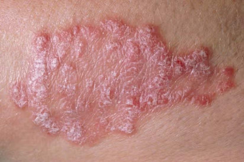Smiling young woman with acne, wearing a white t-shirt.